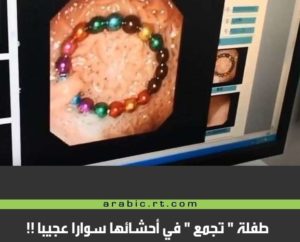 طفله ابتلعت خرزات ممغنطه فتشكلت في معدتها عقداً شاهد كيف انقذوها