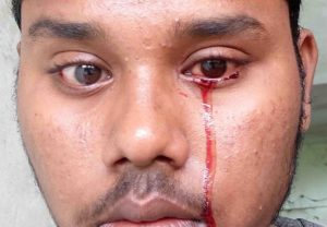 شاب يفاجأ بعينيه تذرفان «دمًا».. ورد صادم من الأطباء