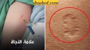 ما حقيقة خبر إذا وجدت ندبة لقاح السل على كتفك فاحتمال إصابتك بـ كورونا ضعيف جدا