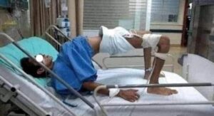 معلومه تساوى حياه! ماذا يفعل مسمار اذا دخل في قدمك !؟