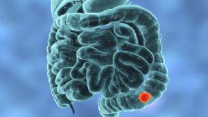 متى؟ وكيف؟! نتعرض للإصابة بسرطان الأمعاء؟