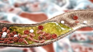 شاهد أول علامة تكشف أن لديك انسداد في الشرايين بسبب الكوليسترول!