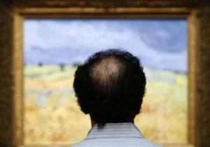 اكتشاف دواء مبتكر يستعيد 80% من الشعر لمرضى الثعلبة