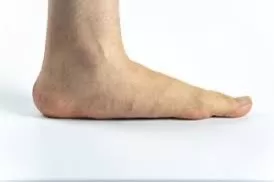 ما الذي يسبب الأقدام المسطحة ؟