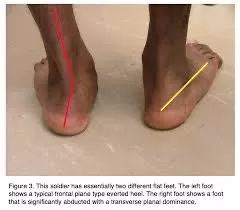 هل هناك علاج للأقدام المسطحة ؟