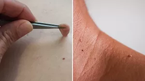 قصة تشكل الزوائد الجلدية على الرقبة وأسبابها