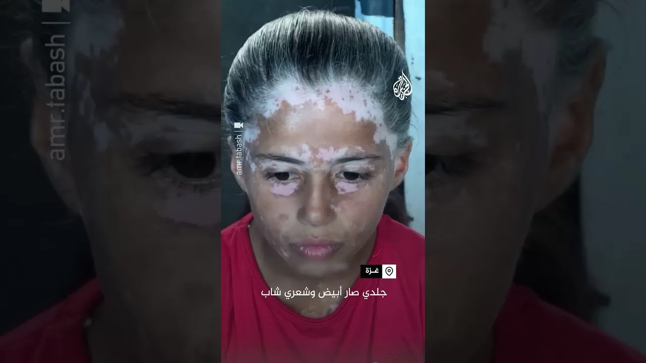 الطفلة لانا الفلسطينية التي شابت نتيجة الخوف الشديد جراء القصف في غزة