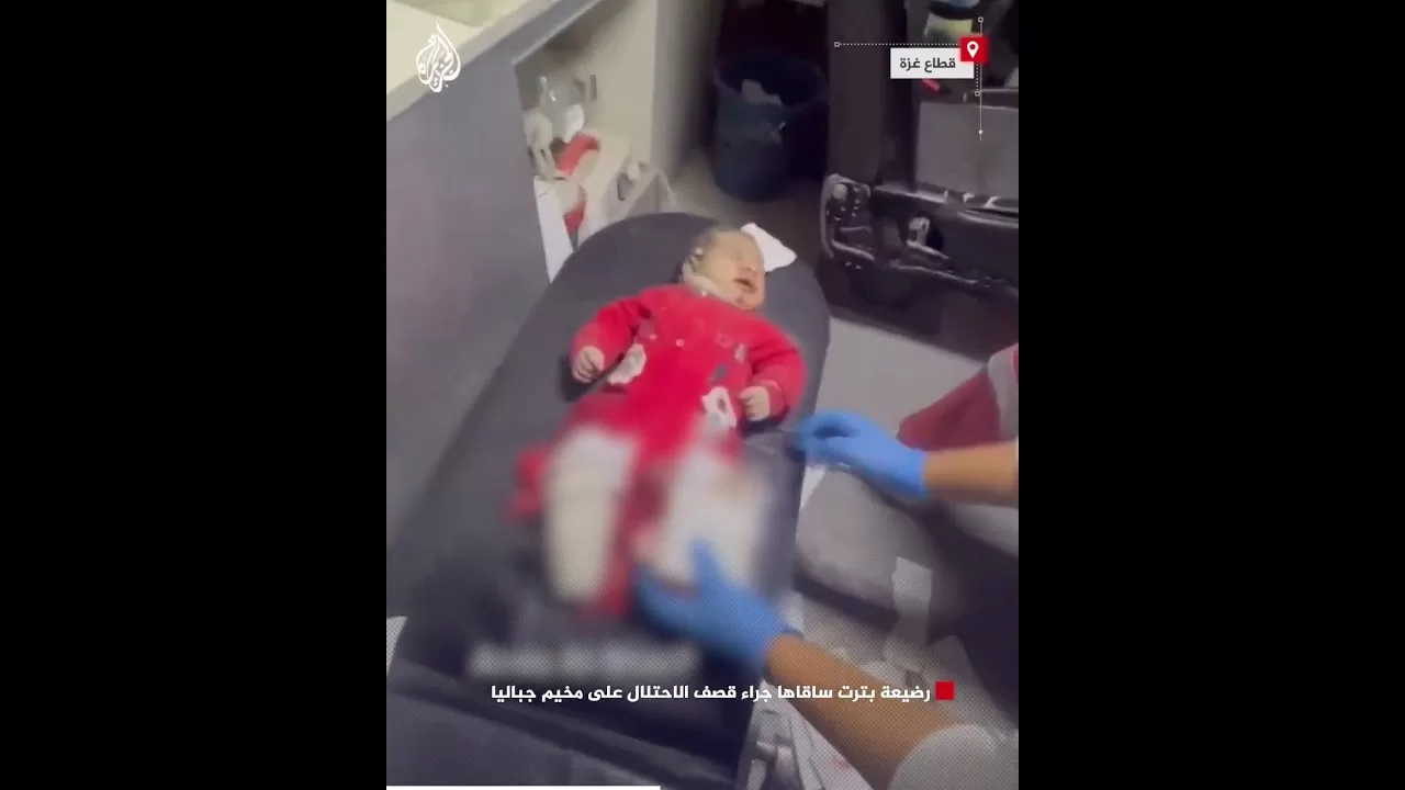 رضيعة بترت ساقاها جراء قصف الاحتلال على مخيم جباليا