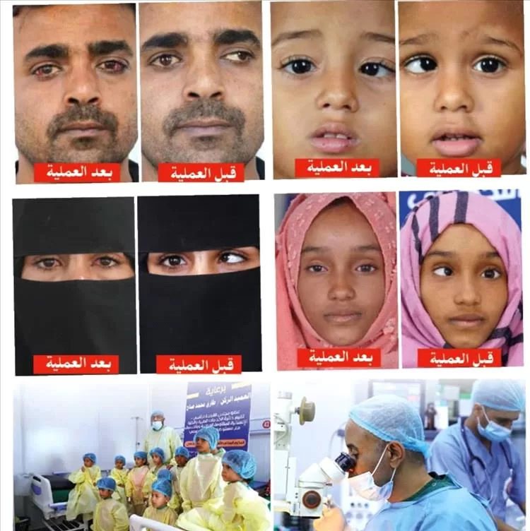 غدًا انطلاق المخيم الطبي المجاني الثاني لجراحة حَوَل العين في المخاء
