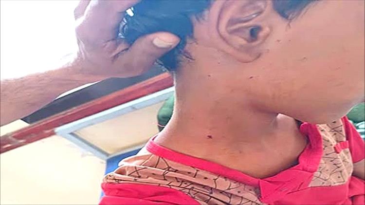 رصاص قناص حوثي يصيب طفلًا في القبيطة بلحج